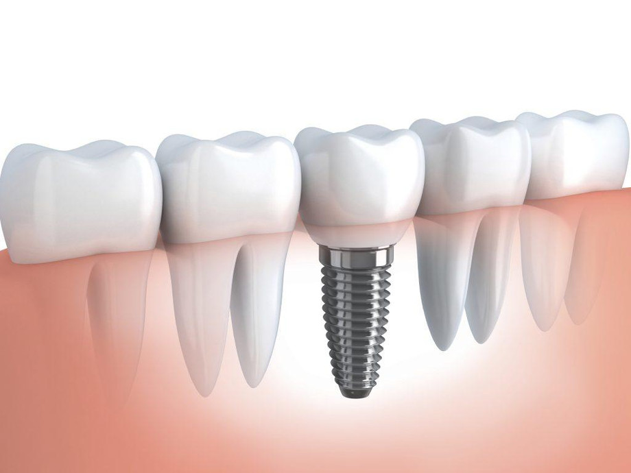 dentalimplants11024x7681.jpg