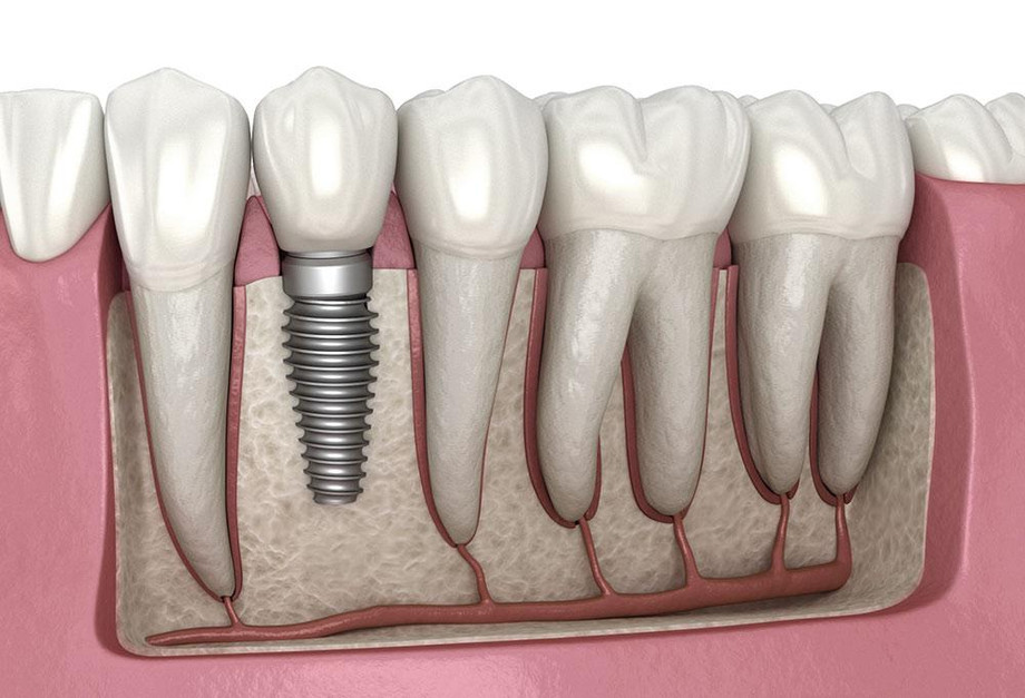 dentalimplantillustration.jpg